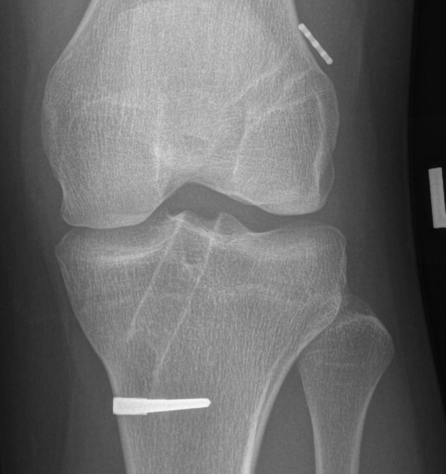 Failed ACL Tibial Lysis